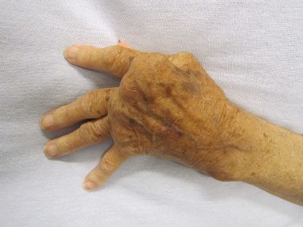 Arthritis Hand Surgery